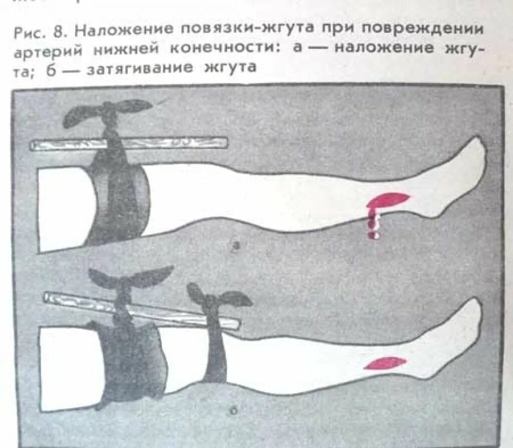 Какой сосуд поврежден. Огнестрельные ранения нижних конечностей. Огнестрельное ранение голени. Огнестрельная рана голени. Наложение жгута при травмах нижних конечностей.