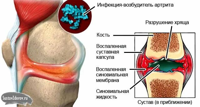 воспалительный процесс колена. воспалительный процесс колена. гнойный бурсит коленного сустава. остеоартрит коленного сустава. септический гнойный артрит.
