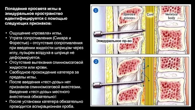 Ощущение провалов. Эпидуральная пространство. Эпидуральная анестезия игла. Катетеризация эпидурального пространства. Признаки попадания иглы в перидуральное пространство.