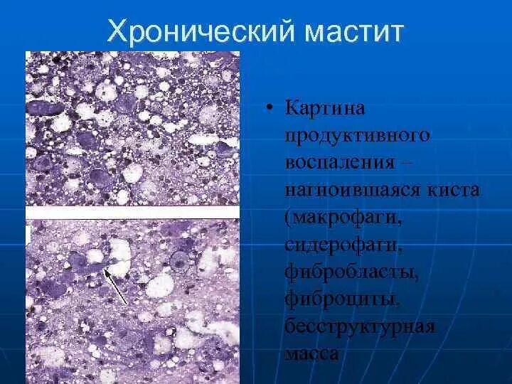 Кистозный солидный образование молочные железа. Хронический мастит гистология. Бесструктурное вещество в цитологии груди. Макрофаги и киста молочной железы.