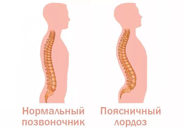 Кифоз и лордоз поясничного отдела. Кифоз грудного отдела позвоночника. Лордоз грудного отдела кифоз поясничного. Лордоз шейного отдела отдела.