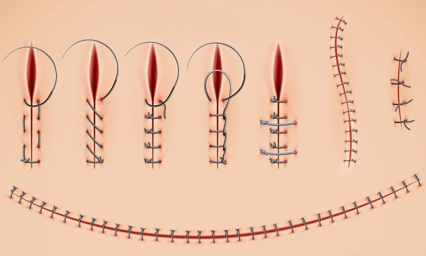 Названия хирургических швов. Швы для шитья хирургия. Как называется шов после операции
