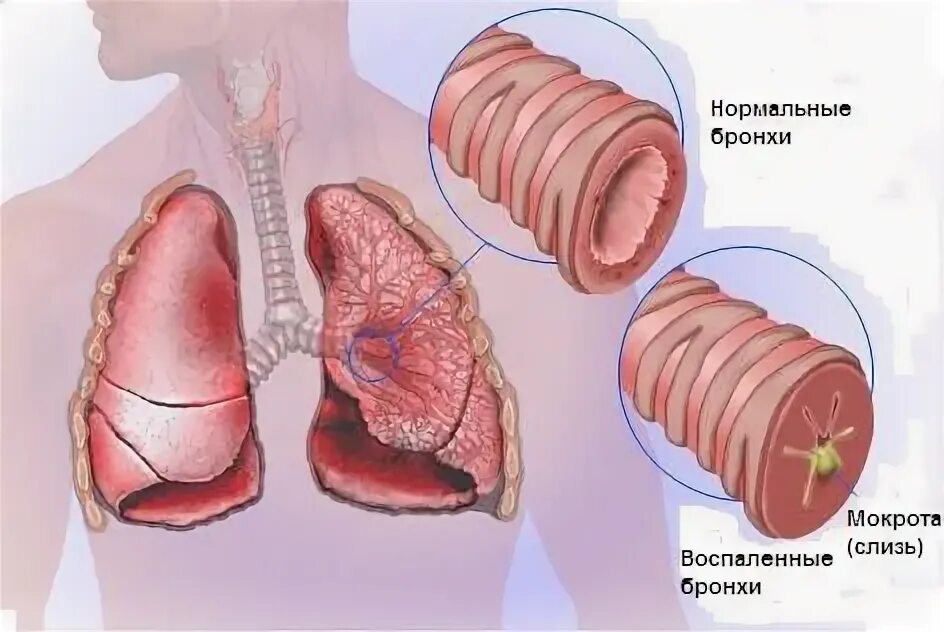 Выведение мокроты из легких