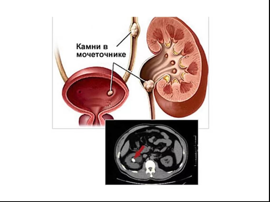 Причины мочекаменного заболевания. Камни в почках мочеточнике и мочевом пузыре. Заболевания мочевыделительной системы мочекаменная болезнь. Мочекаменная болезнь урология камни мочеточника.