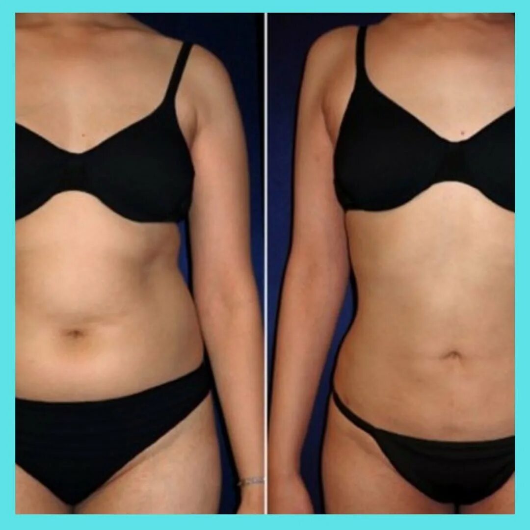 коррекция фигуры в сиреневом фоне. липолитики в бока. коррекция жировых отложений на теле. липозивная липосакция. липолитики целлюформ.