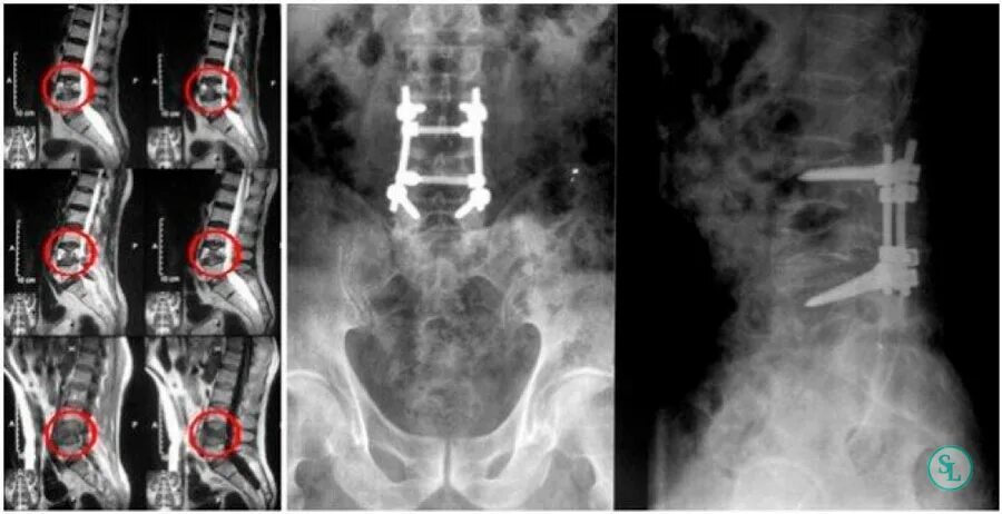 Компрессионный перелом позвоночника рентген. Компрессионный перелом позвонков l3 l4. Компрессионный перелом позвоночника th-5-6. Операция смещение позвоночника