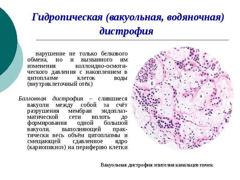 Гидропические изменения клеток печени. Паренхиматозные белковые дистрофии гидропическая. Дистрофия гепатоцитов гистология. Гидропическая эпителия канальцев почек.