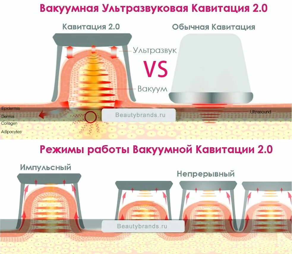 Кавитация как часто можно. Кавитация схема воздействия. Вакуумная ультразвуковая кавитация. Ультразвуковая кавитация схема. Кавитация схема проведения процедуры.