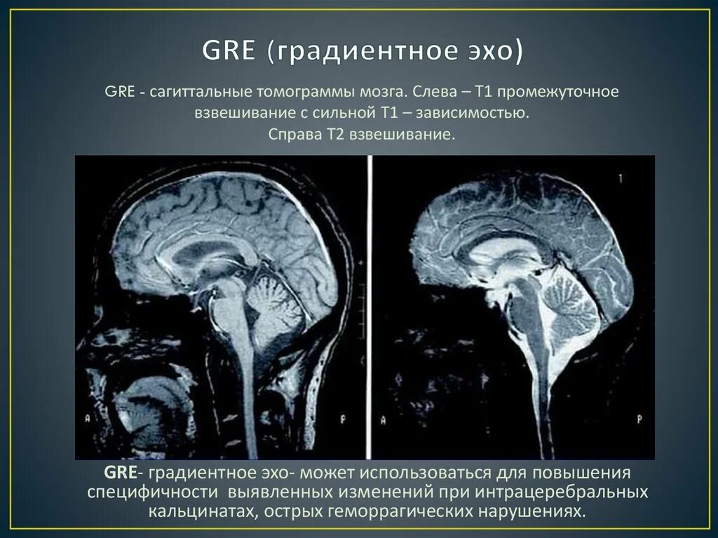 Взвешенное изображение мрт. Взвешенное изображение мрт