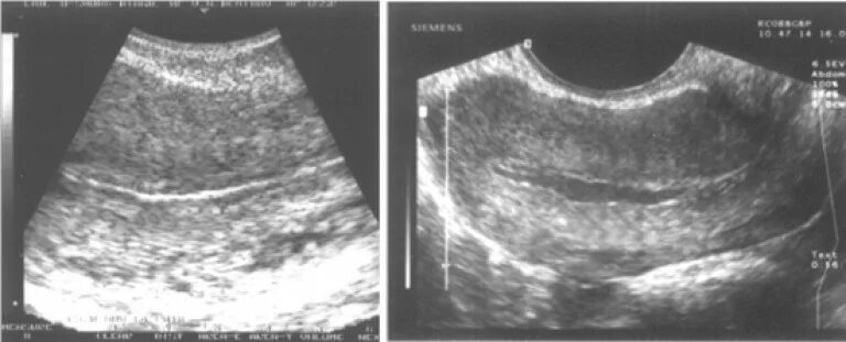 Эндометрии в полости. Послеродовый эндометрит УЗИ. Дифтерический эндометрит.