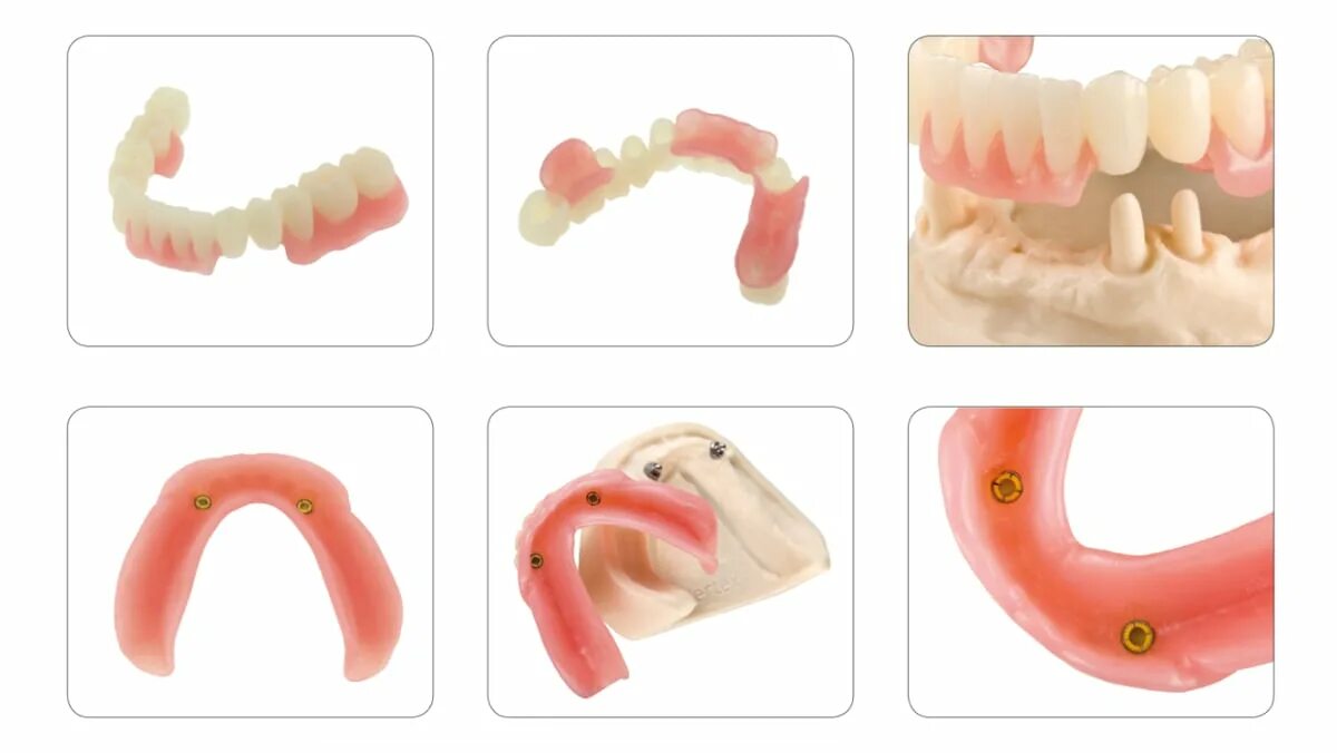 акриловые протезы плюсы. акриловые протезы плюсы и минусы. протез вставная челюсть. съемные зубные протезы минусы. съемные зубные протезы минусы.