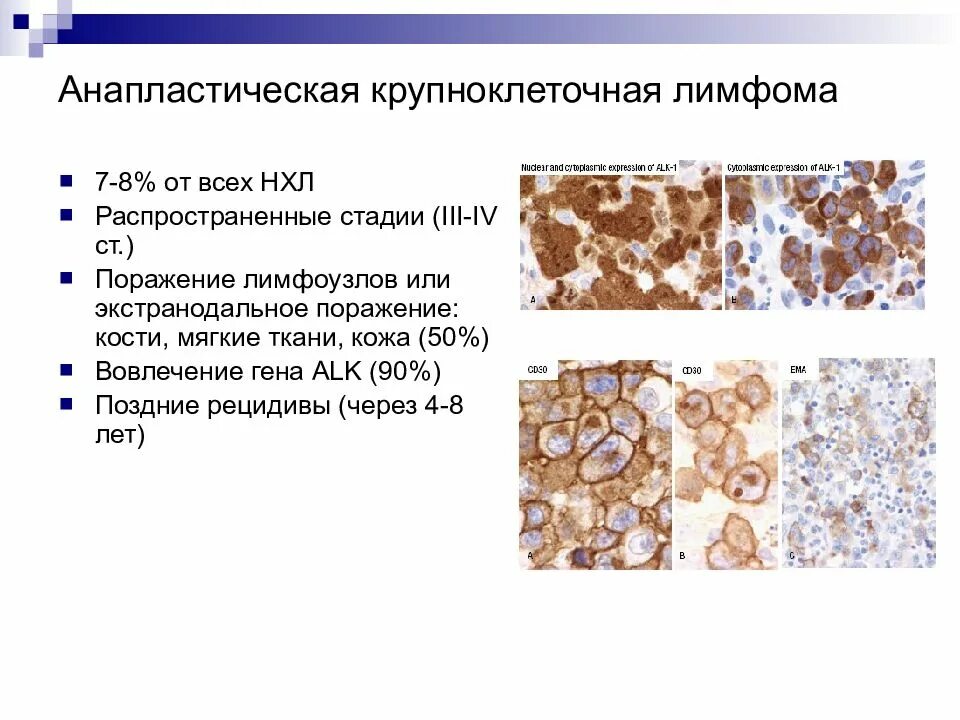 Диффузная неходжкинская. Крупноклеточная лимфома гистология. В крупноклеточная лимфома микропрепарат. Клеточная (неходжкинская) лимфома кожи. Диффузная крупноклеточная в-клеточная лимфома гистология.