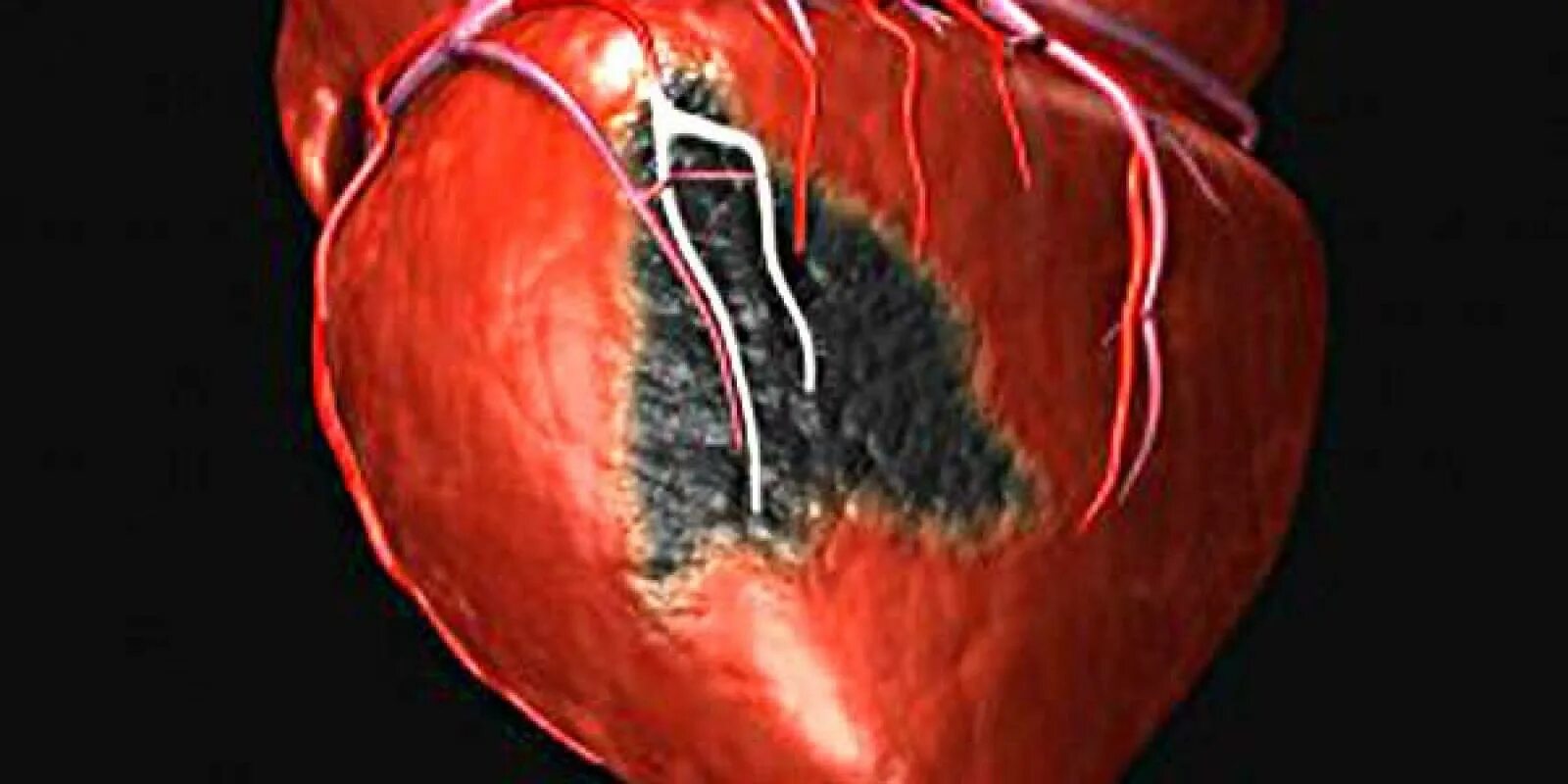 Осложнение на сердце после. Инфаркт миокарда сердце.