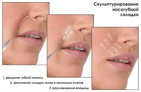 После введения филлера нельзя