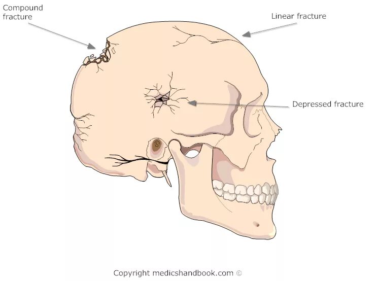 Перелом кости свода черепа. Дырчатый перелом костей черепа. Оскольчатый перелом костей черепа. Перелом свода черепа, перелом основания черепа. Оскольчатый перелом основания черепа.