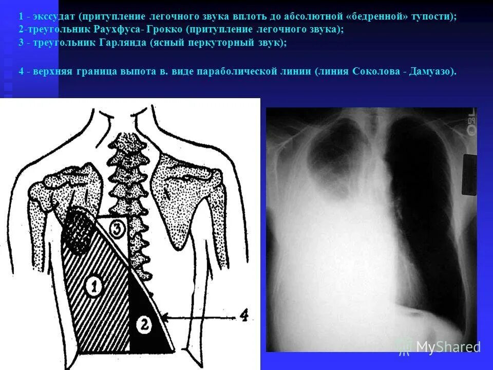 плеврит перкуторный звук