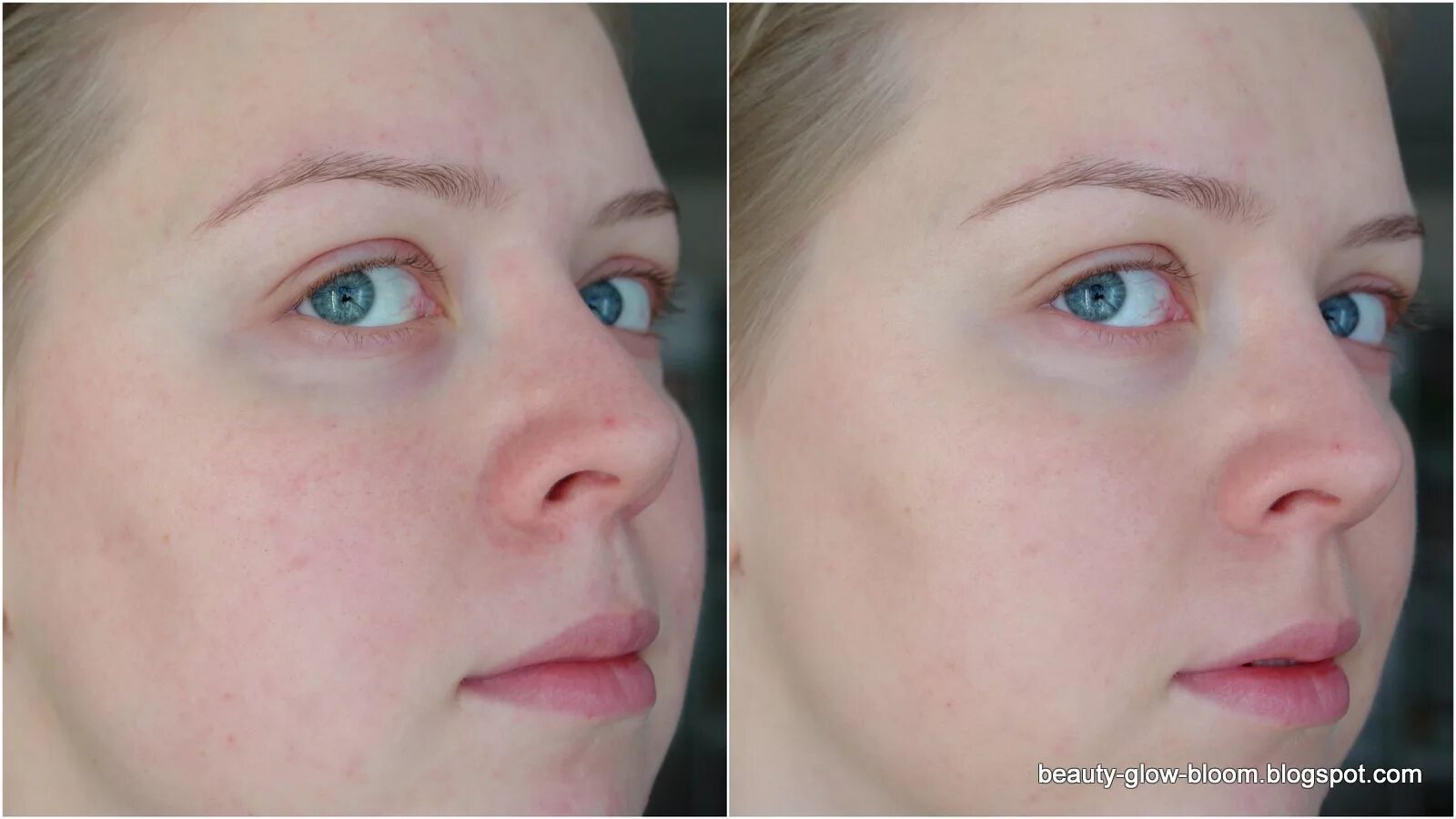 Телеангиоэктазии розацеа. Близко расположены к поверхности. Фототерапия акне/розацеа. Близкопосаденные глаза. Варикоз вен, сосудистые звёздочки.