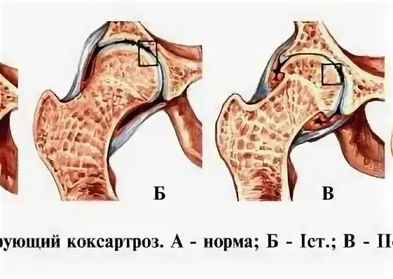 Степени нфс суставов. Степени диспластической коксартроза. нфс 2 степени тазобедренного сустава.