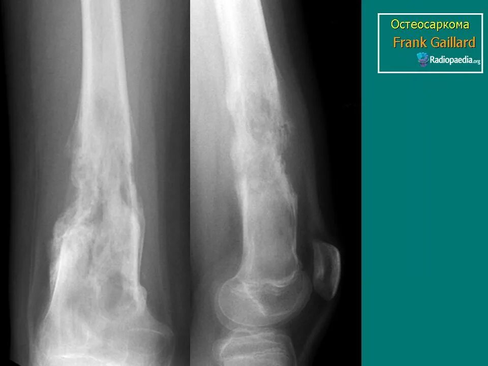 Рак в костях прогноз. Остеосаркома (остеогенная саркома). Остеосаркома бедренной кости рентген.