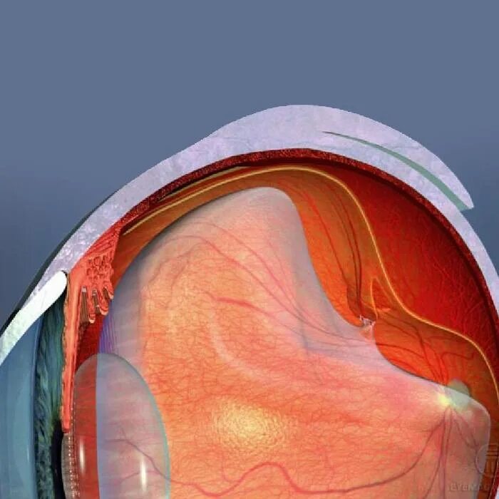 Тракционно-регматогенная отслойка сетчатки. Неопластическая отслойка сетчатки. Пузыревидная отслойка сетчатки. Клапанный разрыв отслойка сетчатки. Стекловидное тело операция