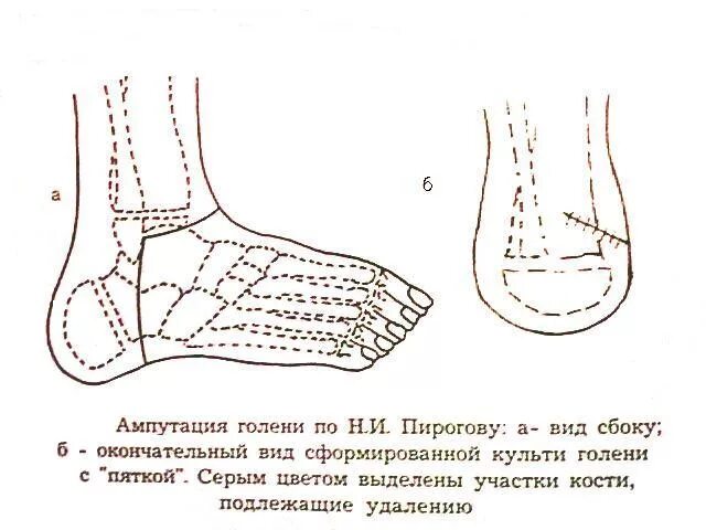 Лоскутная ампутация. Костно пластическая ампутация Пирогова. Пирогов костно-пластическая ампутация голени. Костно-пластическая ампутация голени по н.и. Пирогову. Костнопластическая ампутация голени по Пирогову.