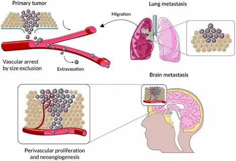 Metastasis