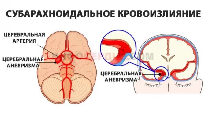 Субарахноидальное кровоизлияние головного мозга. Клинические симптомы субарахноидального кровоизлияния. Субарахноидальное инсульт клиника. Субарахноидальное вентрикулярное кровоизлияние.