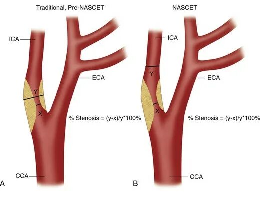 Процент стеноза сосудов. Анатомия сонных артерий УЗИ. Бифуркация общей сонной артерии. Классификация стенозов сонных артерий. Стеноз внутренней сонной артерии.