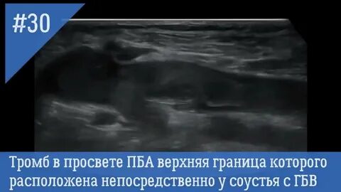 Флотирующий тромб нижней конечности