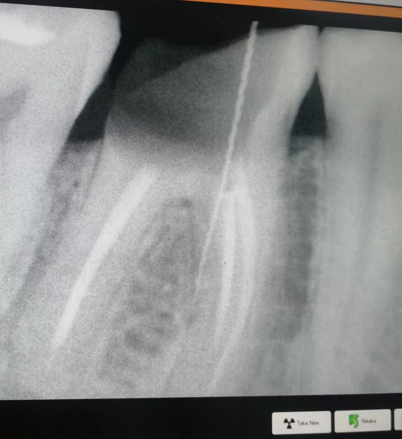 Снимок зубов видное. Перфорация дна полости зуба рентген. Перфорация корневого канала рентген. Перфорация бифуркации зуба. Перфорация корня зуба на рентгене.