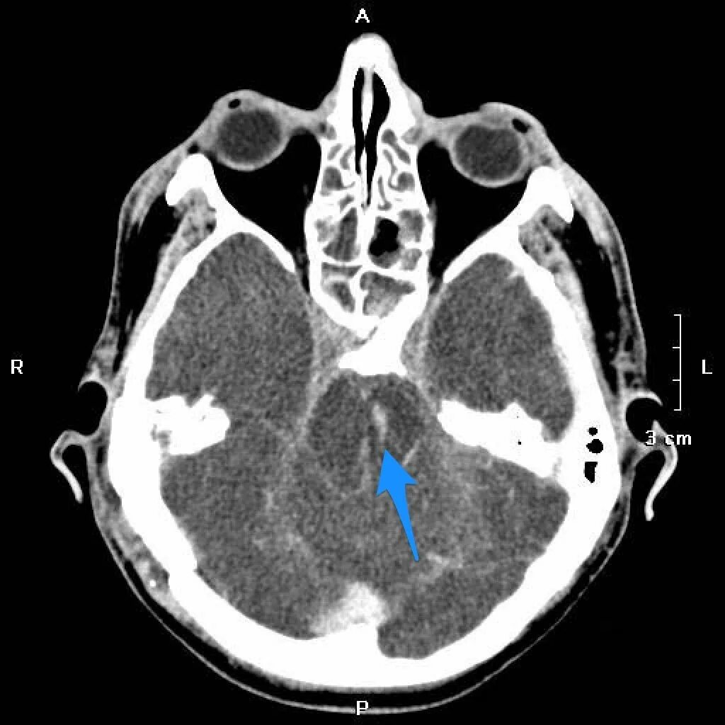 Кровоизлияние в желудочки головного мозга кт. Кровоизлияние в продолговатый мозг кт.