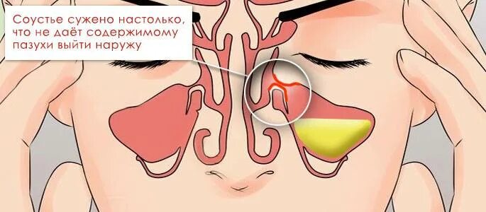 Где накапливаются сопли. Соустье гайморовой пазухи. Где скаплювается сопли. Запах изо носа