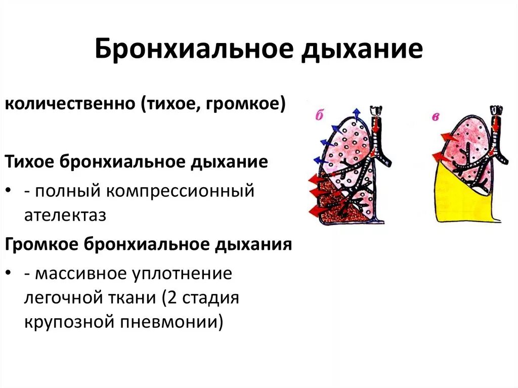 Звук в легких при дыхании. Амфорическое бронхиальное дыхание. Компрессионный ателектаз бронхиальное дыхание. Разновидности патологического бронхиального дыхания. Полостное бронхиальное дыхание.