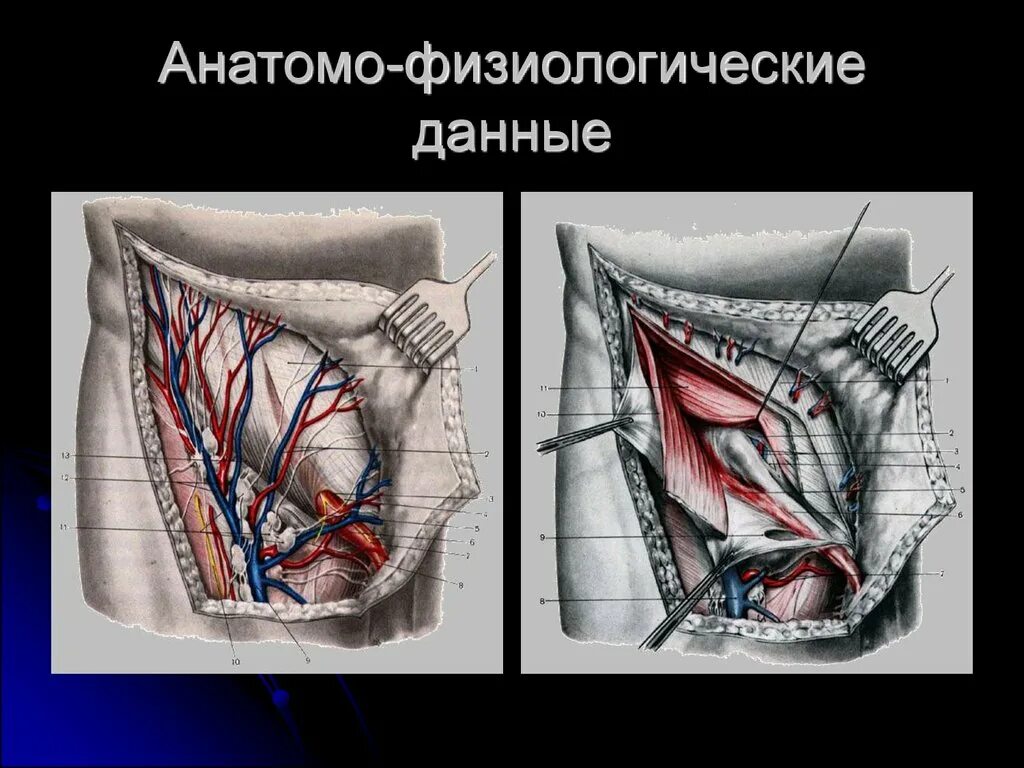 Как называется паховая грыжа