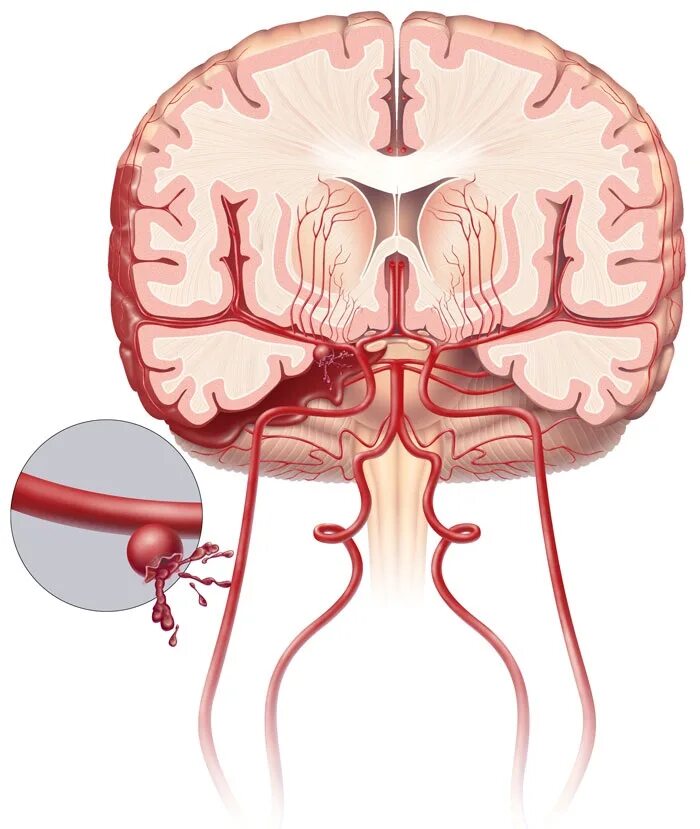 Центральное поражение головного мозга. Субарахноидальное межполушарное кровоизлияние. Субарахноидальное кровоизлияние головного мозга пространство. Субарахноидальные кровоизлияния (Сак). Субарахноидальное кровоизлияние клиника.