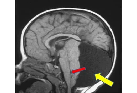 киста сосудистого сплетения у плода. арахноидальная киста на узи. кисти сосудистые сплетения у плода. анатомия мозга плода на узи. кисты сосудистых сплетений на узи 20 недель.