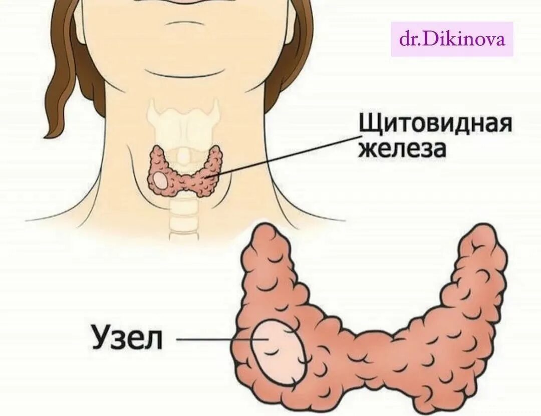 Щитовидная железа зоб узлы. Узловые образования щитовидной железы. Узлы ВЩ итов дной железе. Исследование зоба