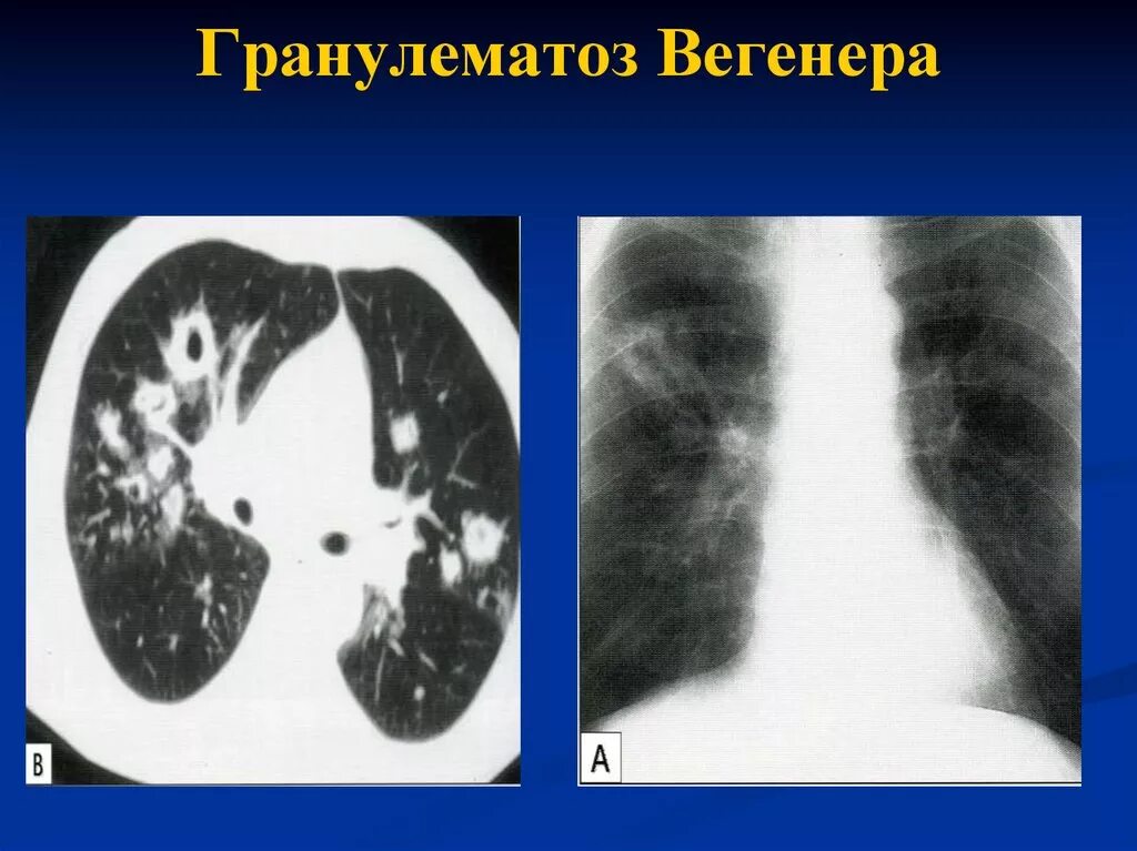 Лимфогранулематоз Вегенера. Васкулит системный. Гранулематоз Вегенера. Болезнь гранулематоз Вегенера. Синдром Вегенера поражение легких. Васкулит вегенера