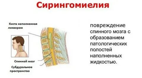 Признаки давнего тяжелого неврологического заболевания спинного мозга