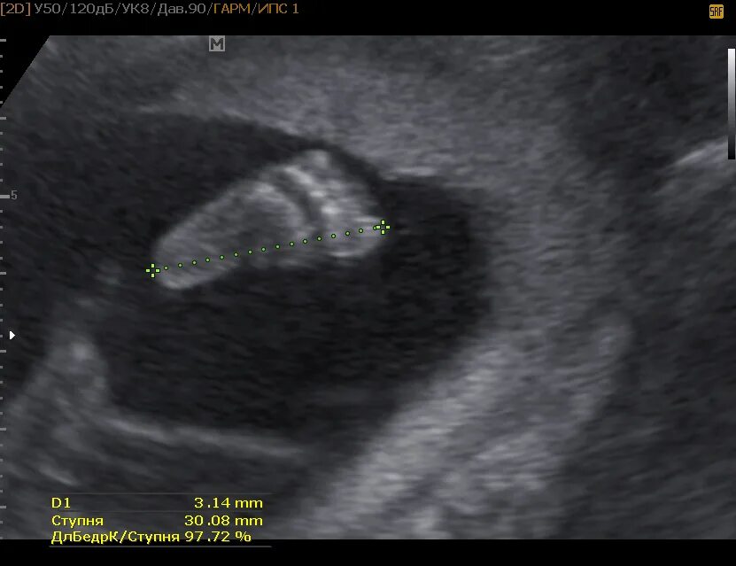 Мозг 20 недель. УЗИ 20 недель беременности фото. Снимок УЗИ плода 20 недель. УЗИ плода на 20 неделе беременности.