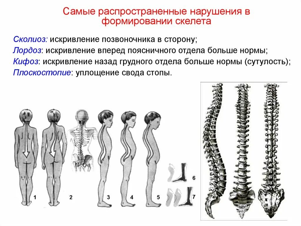 Скелет позвоночника лордоз кифоз. Искривление позвоночника кифоз и лордоз. Лордозы и кифозы скелет туловища человека. Деформации позвоночника кифоз лордоз сколиоз.