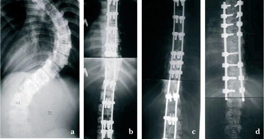 Сколиоз 4 степени операция. Сколиоз позвоночника 4 степени рентген. Сколиоз 3 степени рентген. Конструкция позвоночника операция