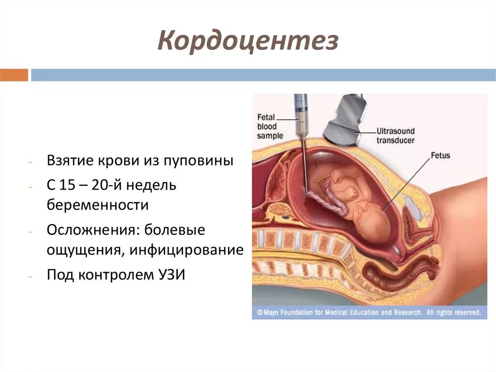 Инвазивный тест при беременности. Амниоцентез и кордоцентез. Кордоцентез диагностические возможности. Кордоцентез инвазивная процедура. Биопсия хориона амниоцентез кордоцентез.