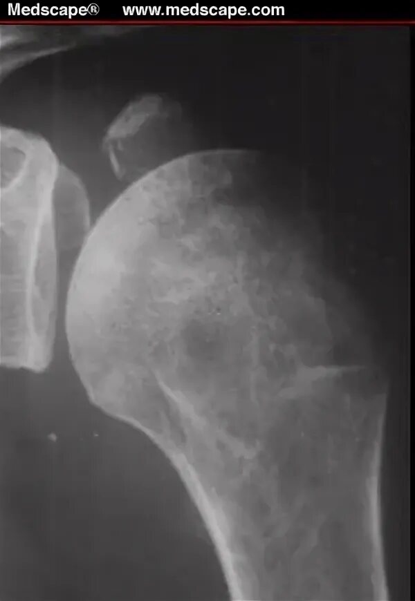 перелом малого бугорка плечевой кости рентгенограмма. перелом большого бугорка без смещения. перелом большого бугорка плечевой кости рентген. перелом большого бугорка плечевой кости. рентгенография перелома бугорка плечевой кости.