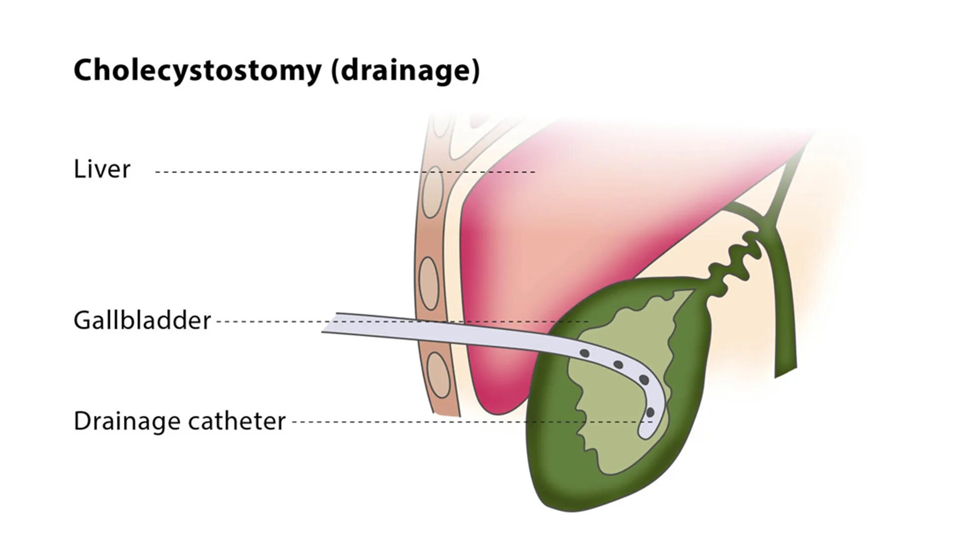Толстый желчный пузырь. Катетер билиарный дренажный. Дренаж после операции желчного пузыря. Транскутанное дренирование желчного пузыря. Дренажный катетер желчного пузыря.