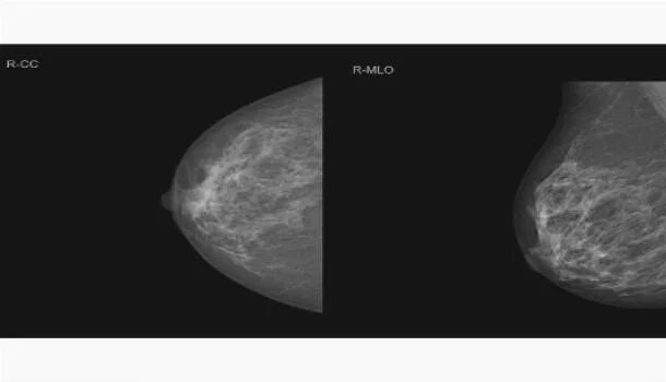 контрастная маммография молочных. цифровой томосинтез молочных желез.