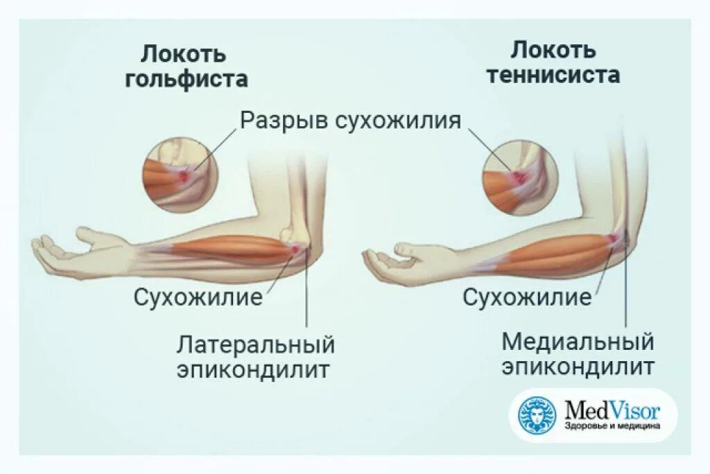 Болят локти после