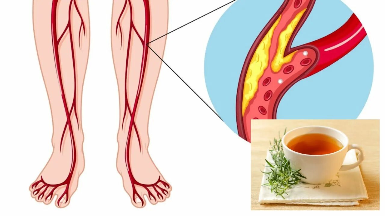 Сильные боли в сосудах. Улучшение кровообращения в ногах. Кровообращение в сосудах ног.