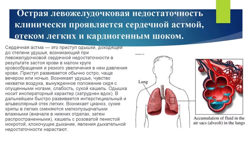 Дыхание при сердечной недостаточности. Острая сердечная недостаточность проявляются отеком легких. Острая левожелудочковая сердечная недостаточность проявляется. Дыхание при левожелудочковой недостаточности. Острая сердечная недостаточность левожелудочковая причины.