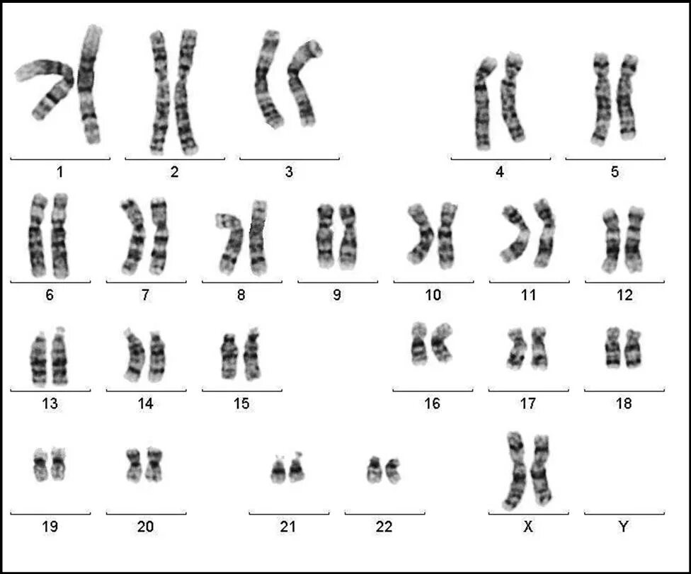 Синдром Клайнфельтера кариотип. Хромосомы при синдроме Клайнфельтера. Синдром Клайнфельтера кариограмма. Синдром Клайнфельтера набор хромосом.